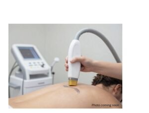 Laser Tattoo Removal - Small Tattoo